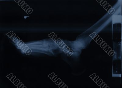 x-ray