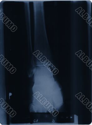 x-ray