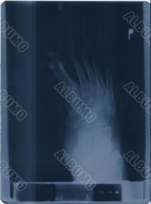 x-ray