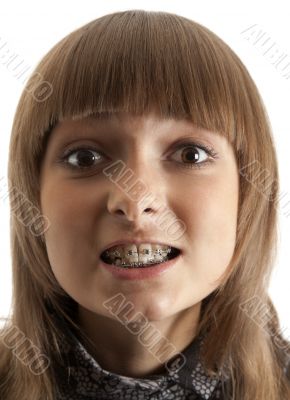 Girl smiles with bracket on teeth