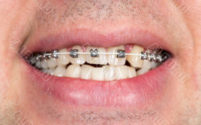 smile with braces on teeth