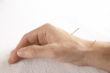 acupuncture of hand