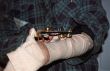 Broken Wrist