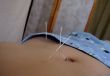 Acupuncture Appointment