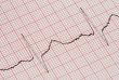ECG graph