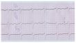 long stripe of ecg