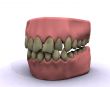 bad hygiene teeth