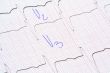 ECG graph with doctor notes