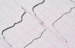 ECG graph