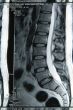 MRI result 1