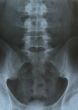 pelvis x-ray