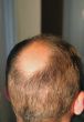 balding head