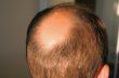 balding head