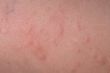 Hives