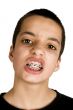 teenage showing his dental  braces