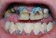 Severe Tooth Decay