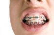 dental braces