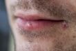 Cold sores (herpes labialis)