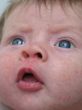young baby with a rash