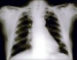 Chest X ray. Human.