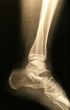 X-ray of a foot