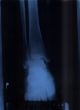x-ray