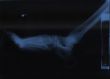 x-ray