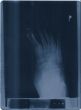x-ray