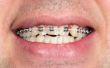 smile with braces on teeth