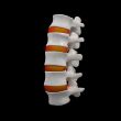 spinal disc
