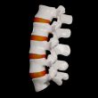 spinal disc