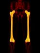3d render medical illustration of the femur bone 